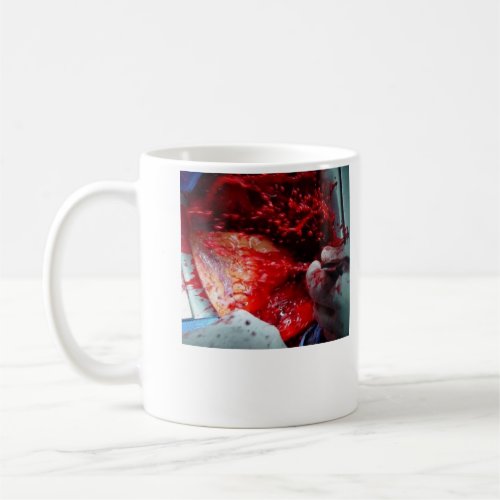 Ascending  Aortic  Dissection Coffee Mug