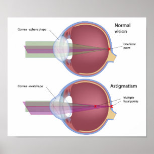 Astigmatism, a common eye defect Poster