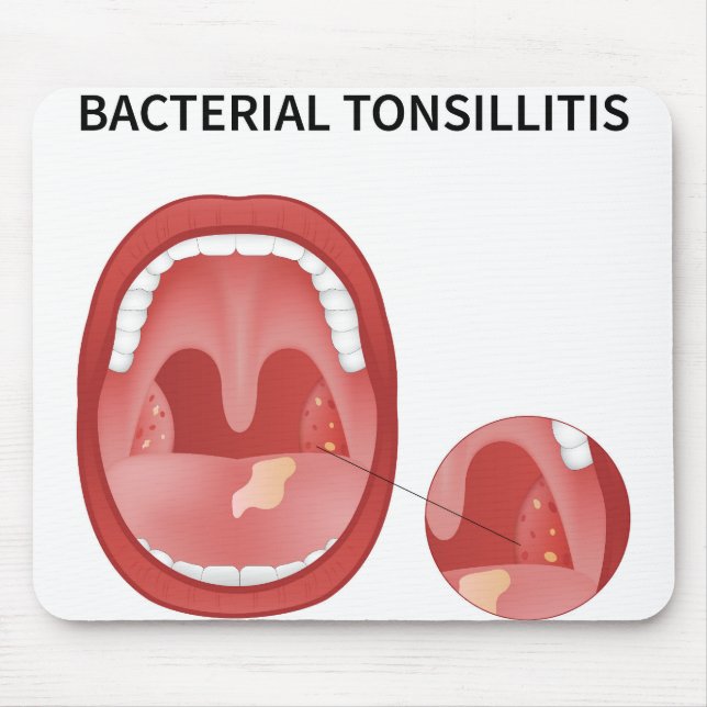 Bacterial tonsillitis mouse pad (Front)
