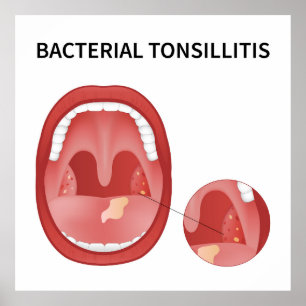 Bacterial tonsillitis poster