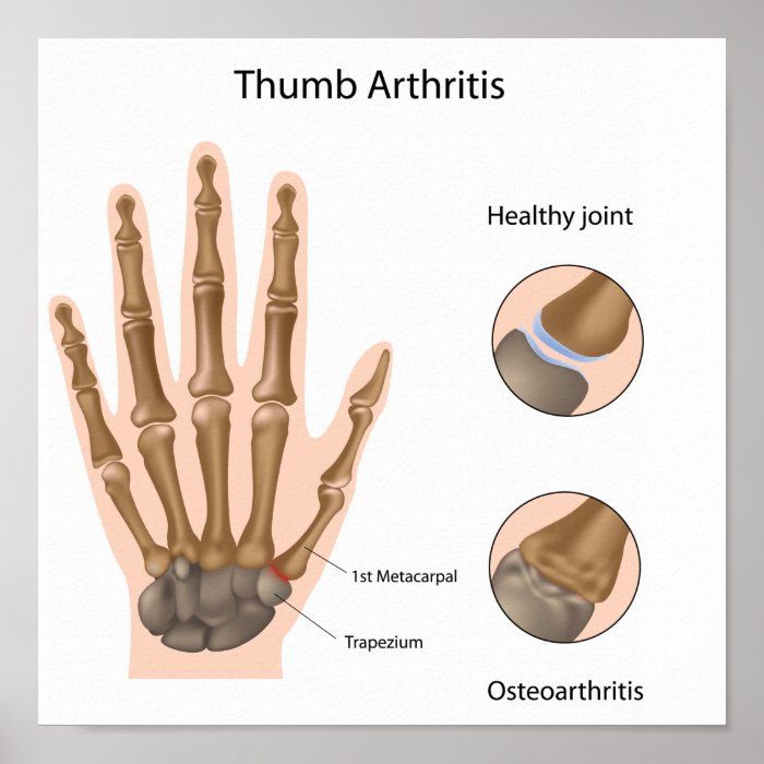 Base of thumb arthritis Poster
