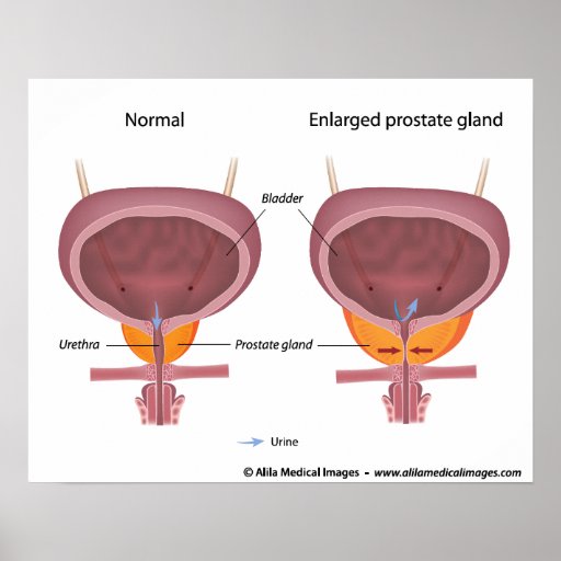 Benign prostatic hyperplasia, labeled diagram. poster | Zazzle