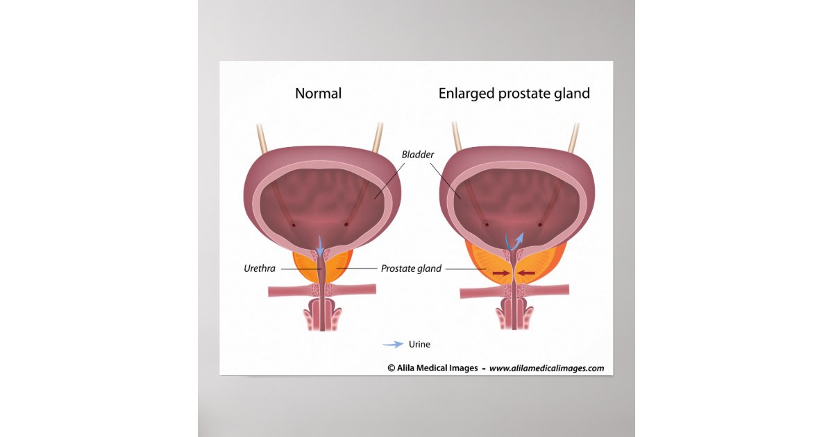 Benign Prostatic Hyperplasia, Labeled Diagram. Poster 