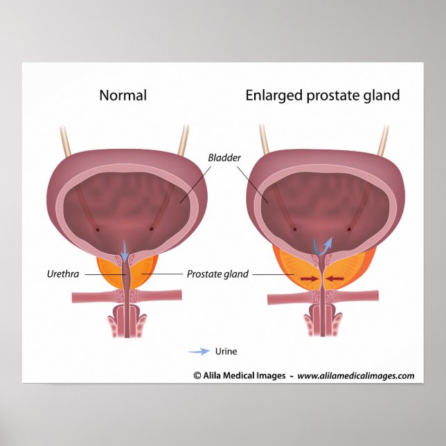 Benign prostatic hyperplasia, labeled diagram. poster (Front)