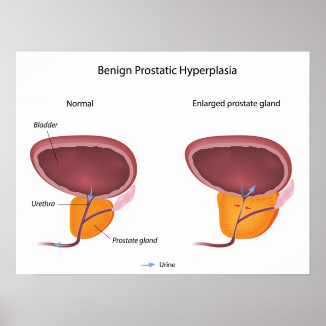 Benign prostatic hyperplasia  Poster (Front)