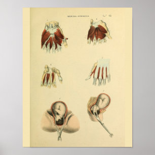 Birth Forceps Obstetrics Anatomy Medical Art Print