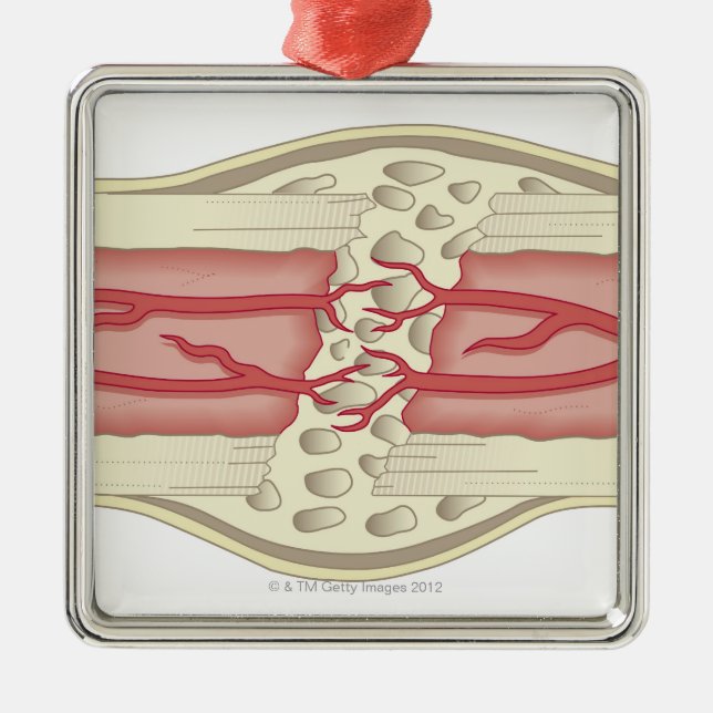 Bone Repairing Itself 2 Metal Ornament (Front)