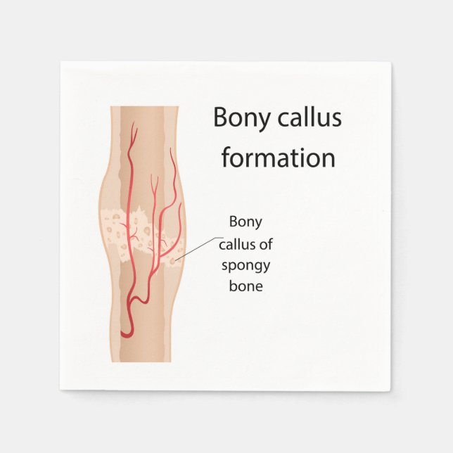 Bony callus formation  napkins (Front)