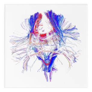 Brain and Tracktography Acrylic Print