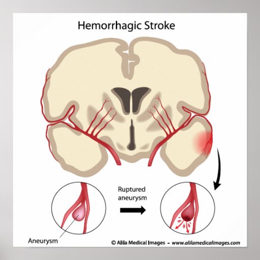 Brain aneurysm diagram. print | Zazzle