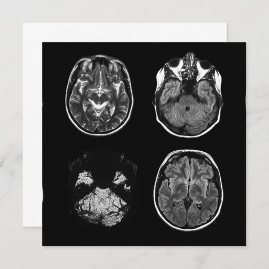 Brain MRI scan (Front/Back)