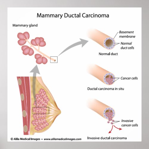 Breast cancer ductal carcinoma  labeled diagram poster