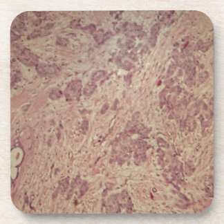 Breast cancer under the microscope coaster