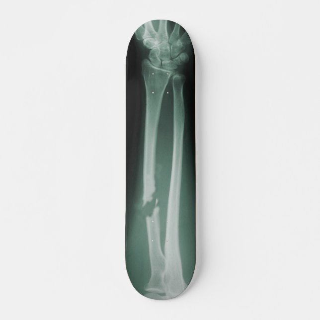 Broken Bones Skateboard Deck (Front)