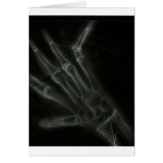 Broken Hand X-ray (Front)