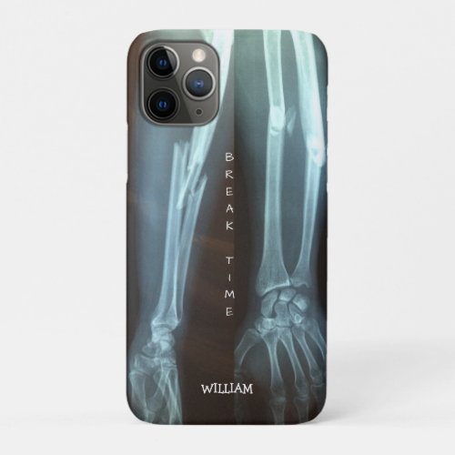 Broken Radius and Ulna Xray Break Time    iPhone 11 Pro Case