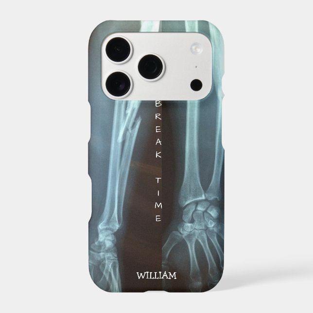 Broken Radius and Ulna Xray "Break Time"    Iphone Case (Back)
