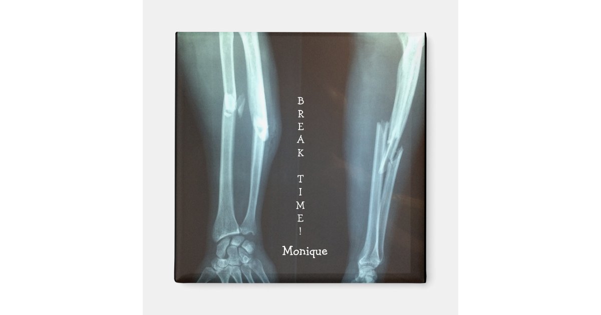 Broken Radius and Ulna Xray 