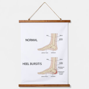Calcaneal bursitis hanging tapestry