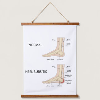 Calcaneal bursitis hanging tapestry