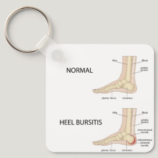 Calcaneal bursitis keychain