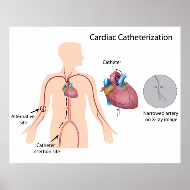 Cardiac catheterization Poster (Front)