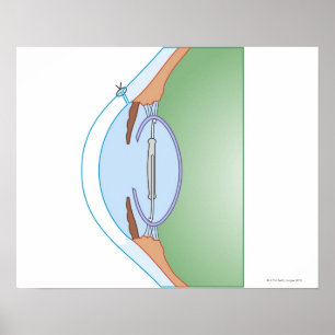 Cataract Surgery Poster