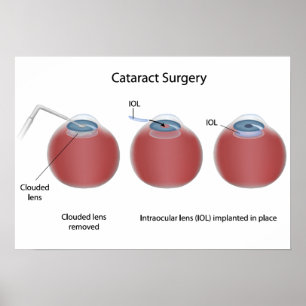 Cataract surgery Poster