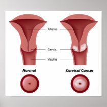 Cervical cancer  Poster