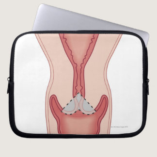 Cervical Conization Biopsy Laptop Sleeve