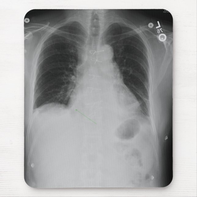 Chest X-Ray ~ mousepad (Front)