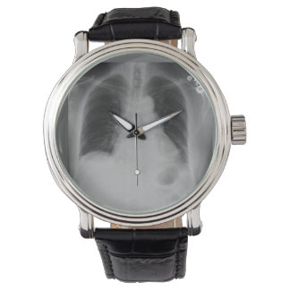 Chest X Ray ~ watch