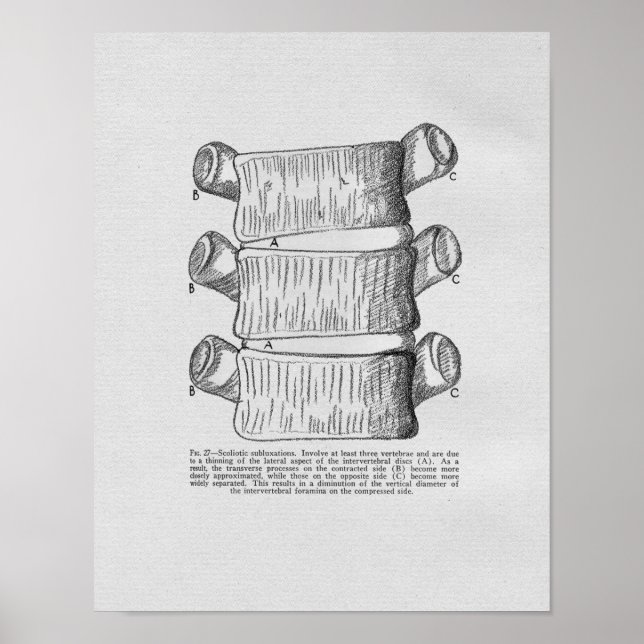 Chiropractic Vertebral Subluxation Vintage Print (Front)