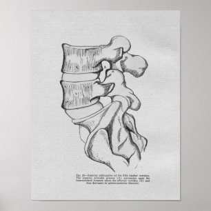 Chiropractic Vertebral Subluxation Vintage Print