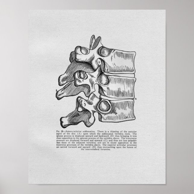 Chiropractic Vertebral Subluxation Vintage Print (Front)