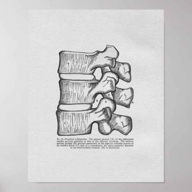 Chiropractic Vertebral Subluxation Vintage Print (Front)