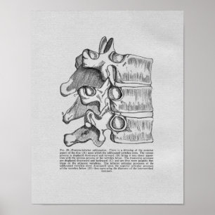 Chiropractic Vertebral Subluxation Vintage Print