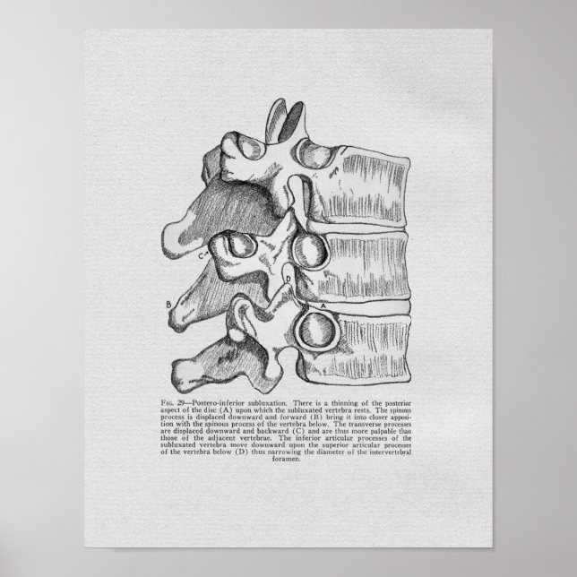 Chiropractic Vertebral Subluxation Vintage Print (Front)