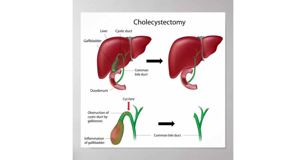 Cholecystectomy gallbladder removal surgery Poster | Zazzle