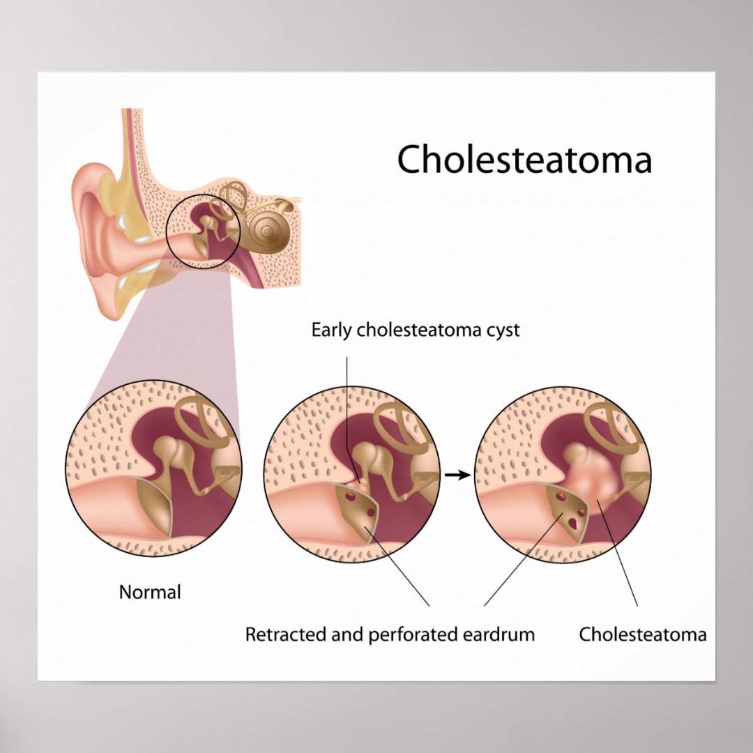 Cholesteatoma middle ear tumor Poster | Zazzle