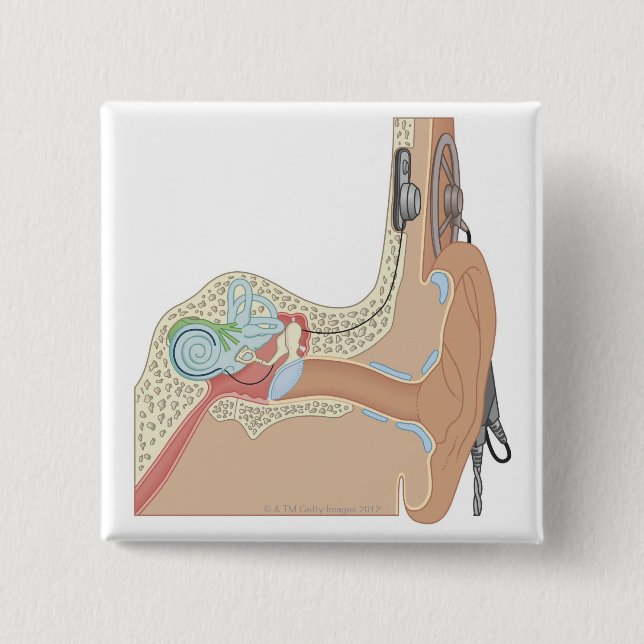 Cochlear Implants Button (Front)