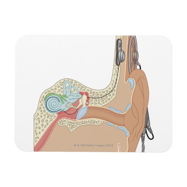Cochlear Implants Magnet (Horizontal)