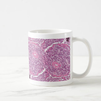 Coffe Mug-Lung Cancer Cells Coffee Mug