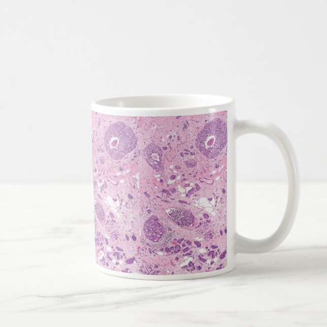 Coffee Mug-Breast Cancer Cells Mug (Right)