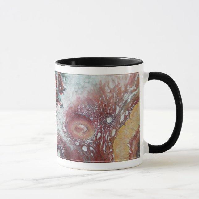 coffee mug! "Malignant Struma Ovarii" Mug (Right)