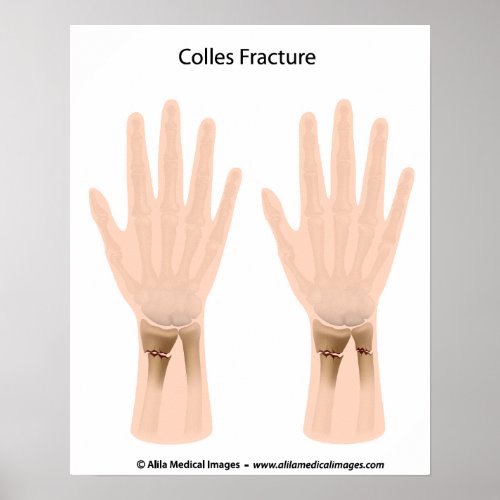 Colles fracture medical illustration poster