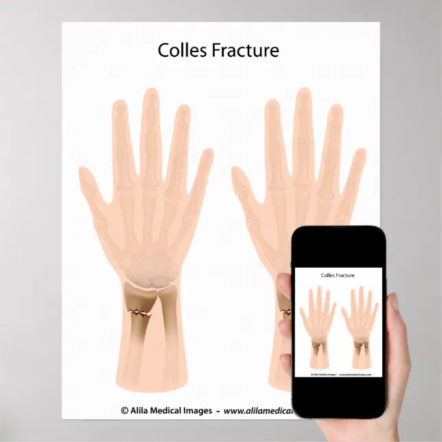 Colles fracture, medical illustration. poster | Zazzle