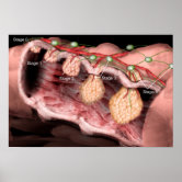 malignant hyperthermia poster