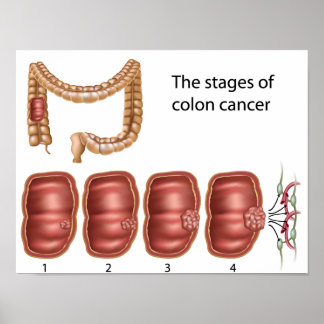 Colon cancer progression Poster