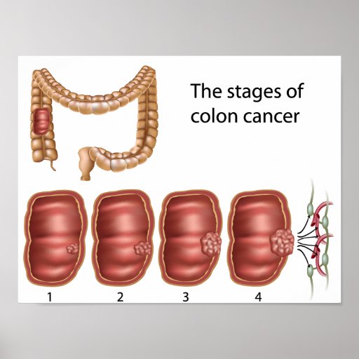 Colon cancer progression Poster | Zazzle